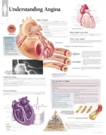 Bol.com Understanding Angina Laminated Poster aanbieding